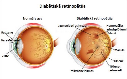sudzibas diabetaiska retinopatija
