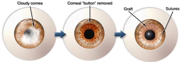 CornealTransplant