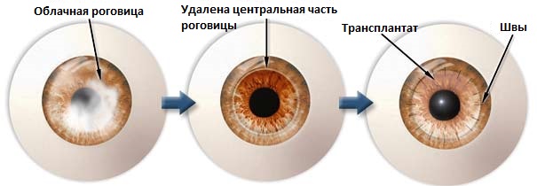 CornealTransplantRUS