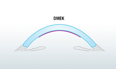 DMEK attels 28.11.2016