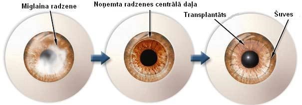 Radzenes operacijas atteli 28.11.2016