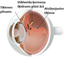Tikleneslv