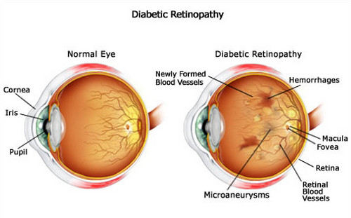 kezelése retina peeling diabetes