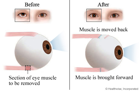 strabismus