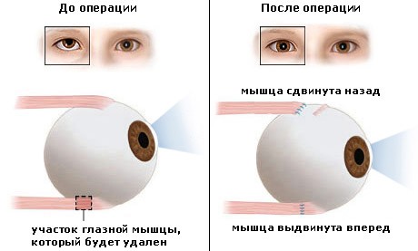 strabismusRUS