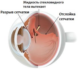 tiklenesplisumsRUS