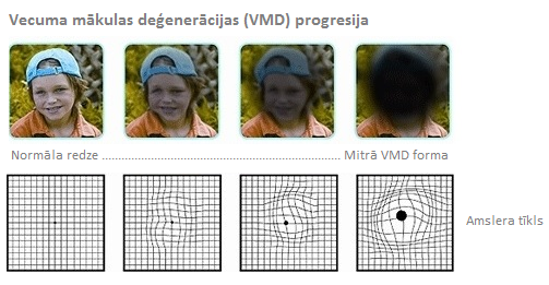 vecuma makulas degeneracijas progresija