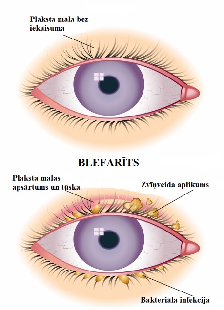 Аллергия на веках глаз. Лечение в Международном центре охраны здоровья